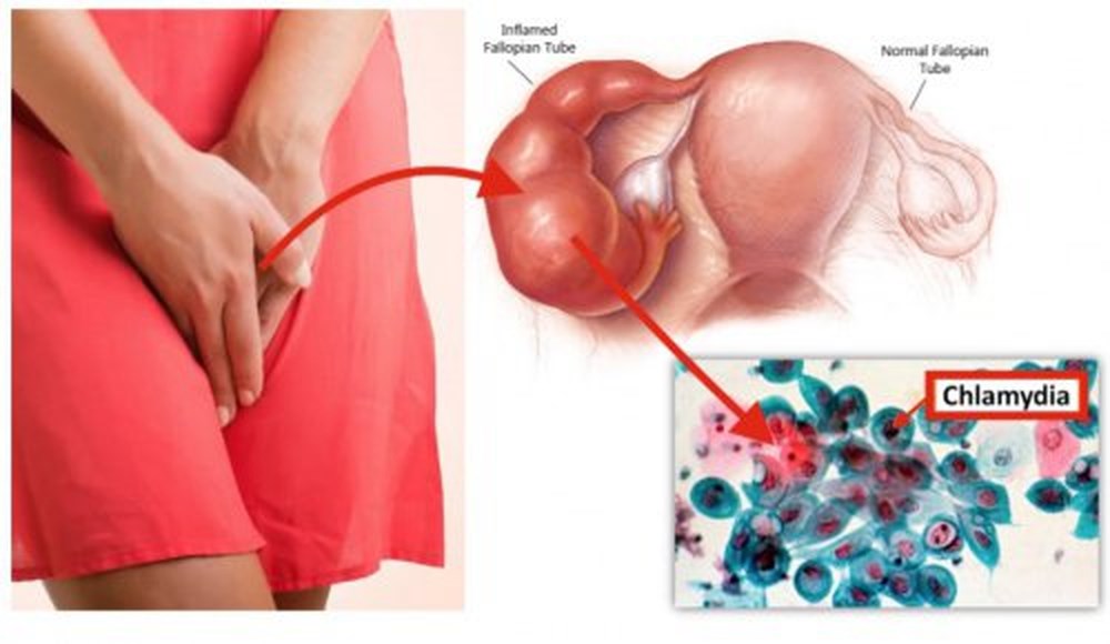 Chlamydia